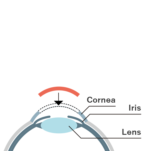 Penetrating Keratoplasty