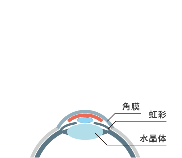 角膜内皮移植イメージ