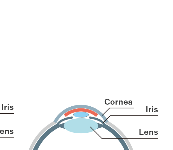 Endothelial Keratoplasty (DMEK, DSAEK etc.)