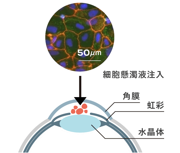 CLS001細胞移植イメージ