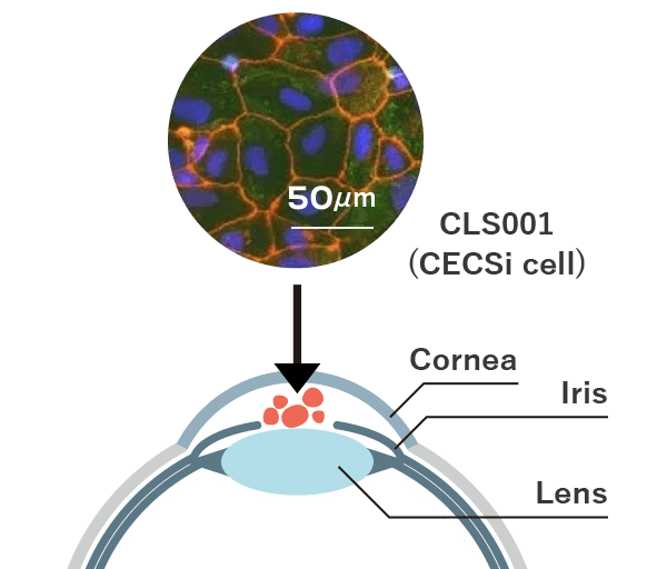 Allogenic CLS001 Cell Transplantation